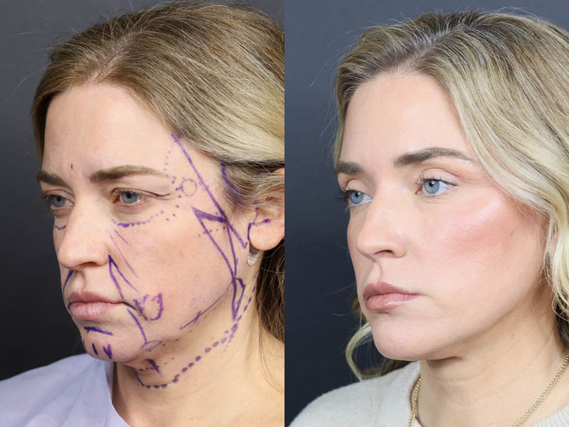 C02 Laser case #11314