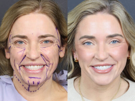 C02 Laser case #11314