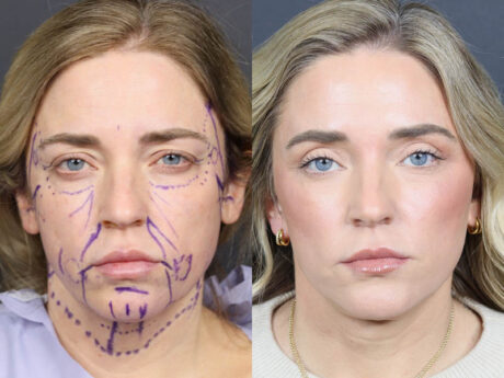 C02 Laser case #11314