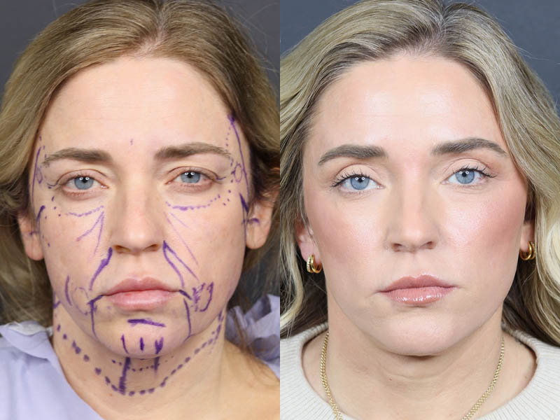 C02 Laser case #11314