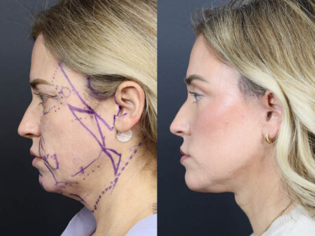 C02 Laser case #11314