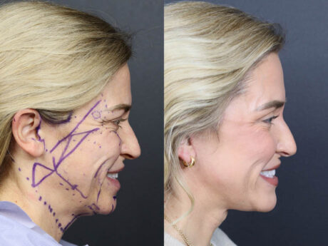 C02 Laser case #11314