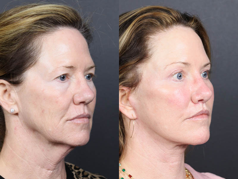 Brow Lift case #11321