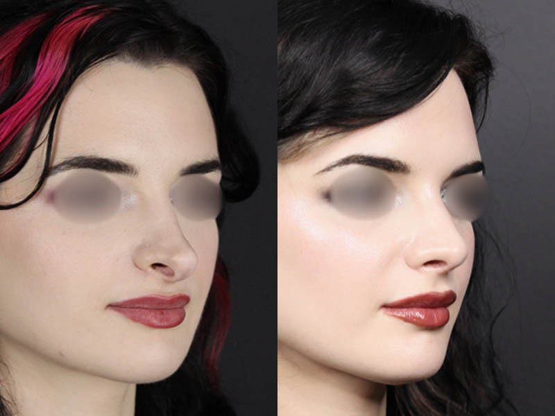 Revision Rhinoplasty case #11326