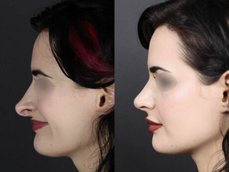 Revision Rhinoplasty case #11326
