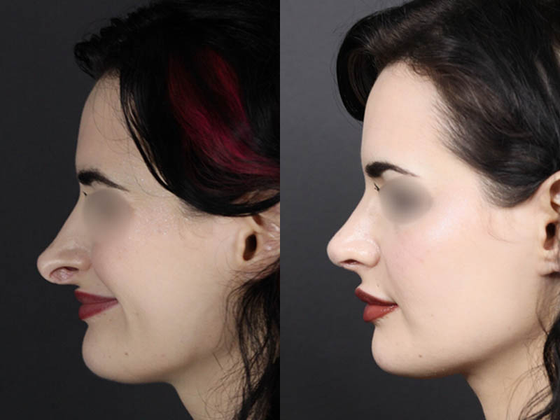 Revision Rhinoplasty case #11326