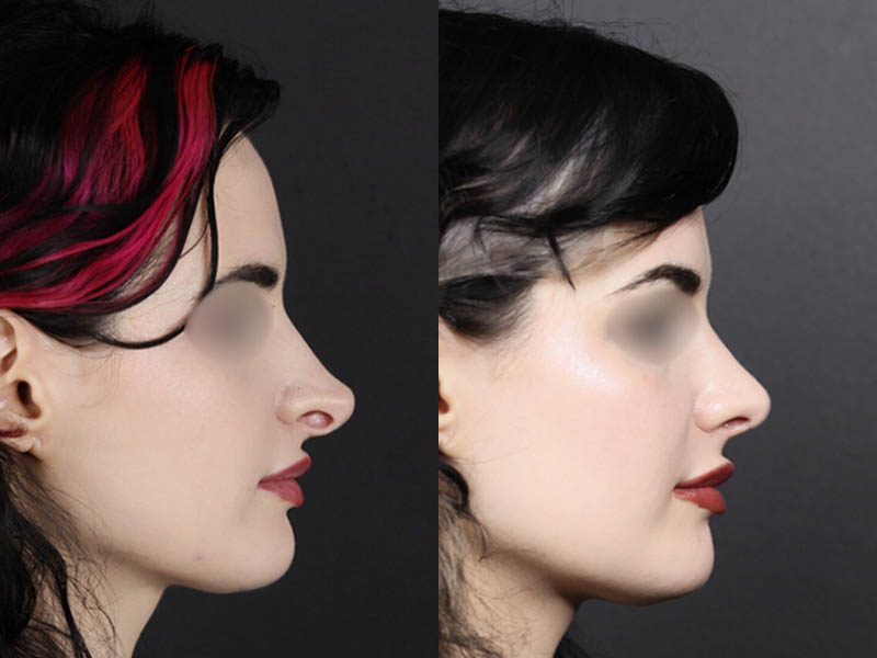 Revision Rhinoplasty case #11326