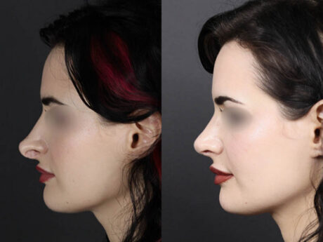 Revision Rhinoplasty case #11326