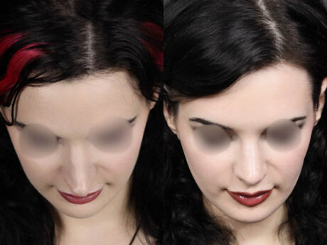 Revision Rhinoplasty case #11326