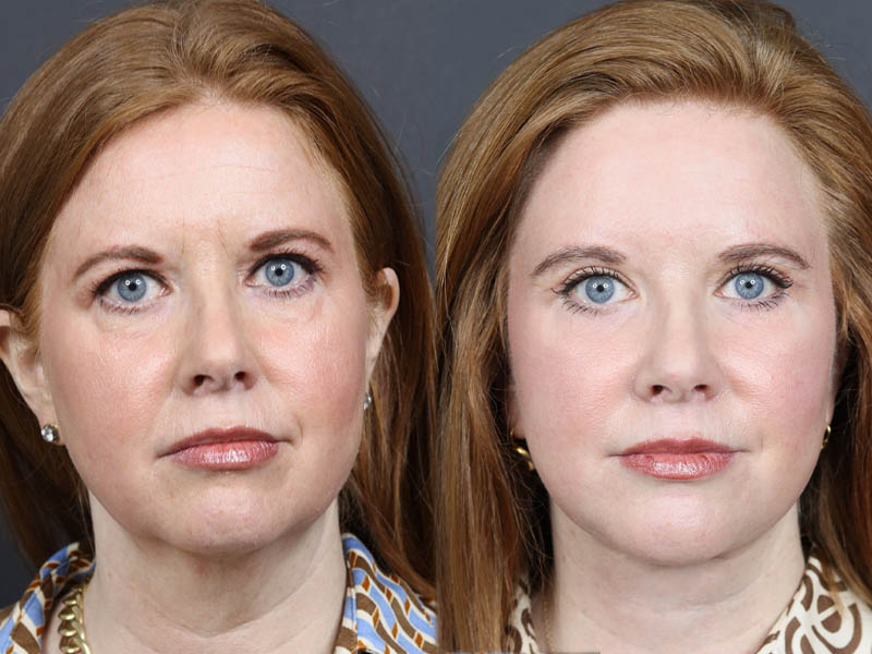 C02 Laser case #11308