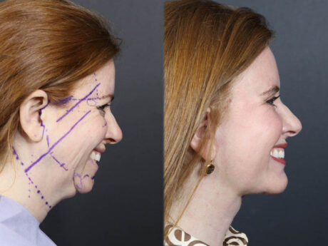 C02 Laser case #11308