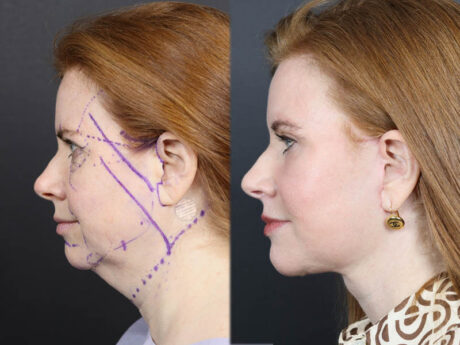 C02 Laser case #11308