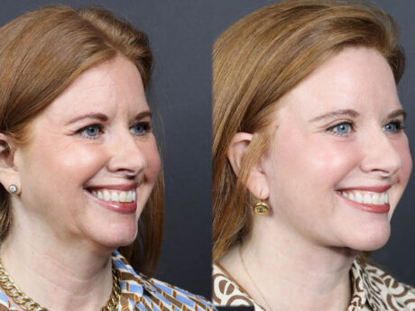 C02 Laser case #11308