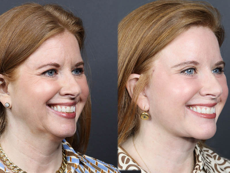 C02 Laser case #11308