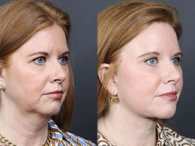 C02 Laser case #11308