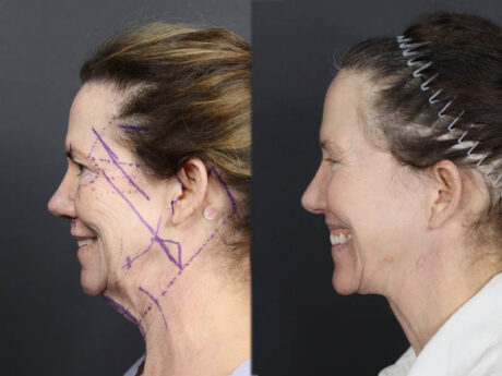 Facelift case #11321