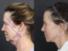 Facelift case #11321 slider thumbnail
