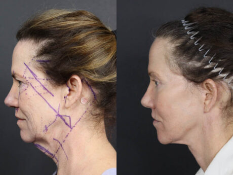 Facelift case #11321