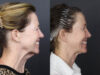 Facelift case #11321 slider thumbnail