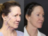 Facelift case #11321 slider thumbnail