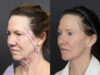 Facelift case #11321 slider thumbnail