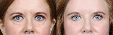 Lower Blepharoplasty case #11442