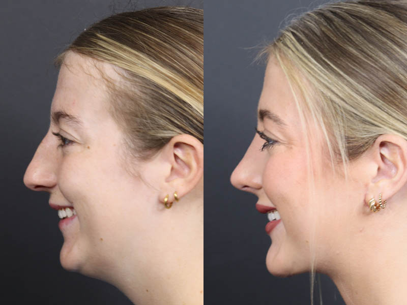 Necklift case #11425