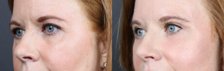 Lower Blepharoplasty case #11442