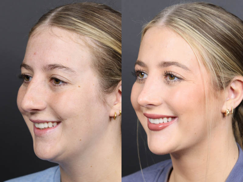 Necklift case #11425