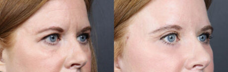 Lower Blepharoplasty case #11442