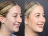 Rhinoplasty case #11434 slider thumbnail