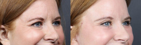 Lower Blepharoplasty case #11442