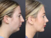 Rhinoplasty case #11434 slider thumbnail