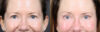 Lower Blepharoplasty case #11447 slider thumbnail