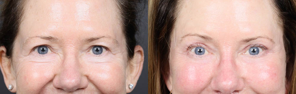 Lower Blepharoplasty case #11447