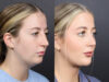 Rhinoplasty case #11434 slider thumbnail