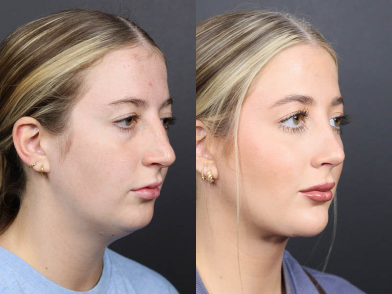 Necklift case #11425