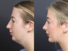 Rhinoplasty case #11434 slider thumbnail