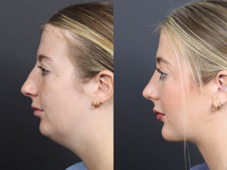 Rhinoplasty case #11434