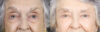 Lower Blepharoplasty case #11451 slider thumbnail