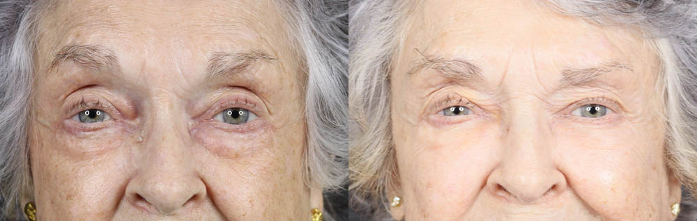 Lower Blepharoplasty case #11451