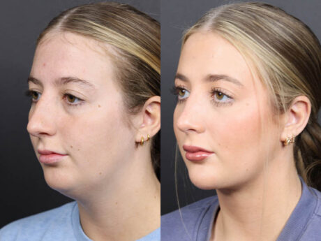 Rhinoplasty case #11434