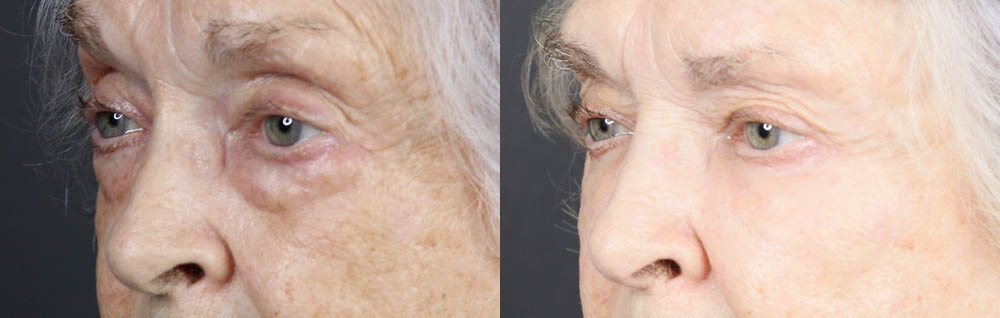 Lower Blepharoplasty case #11451