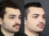 Rhinoplasty case #11419 slider thumbnail