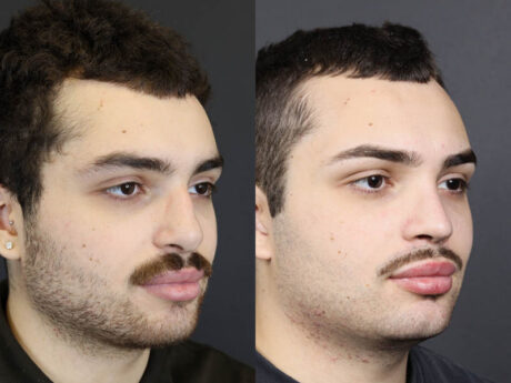 Rhinoplasty case #11419