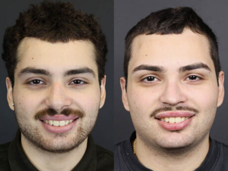 Rhinoplasty case #11419