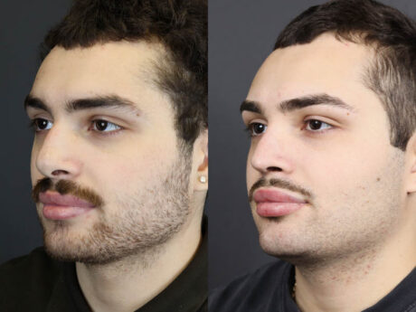 Rhinoplasty case #11419