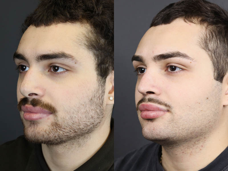 Rhinoplasty case #11419