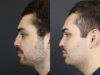 Rhinoplasty case #11419 slider thumbnail