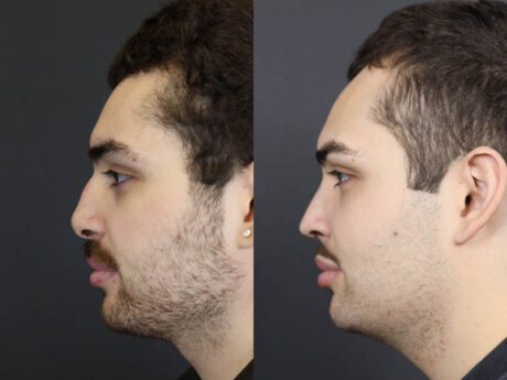 Rhinoplasty case #11419